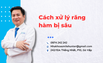 Cách xử lý răng hàm bị sâu