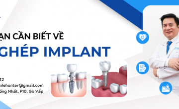 4 ĐIỀU BẠN CẦN BIẾT TRƯỚC KHI QUYẾT ĐỊNH TRỒNG RĂNG IMPLANT