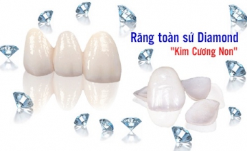 RĂNG SỨ KIM CƯƠNG/RĂNG SỨ DIMOND LÀ GÌ? GIÁ RĂNG SỨ DIAMOND CÓ ĐẮT KHÔNG?