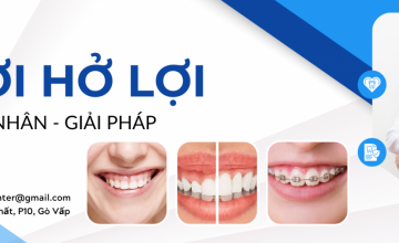 CƯỜI HỞ LỢI - NGUYÊN NHÂN VÀ CÁCH KHẮC PHỤC