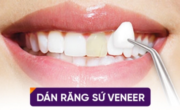 Dán sứ Veneers thẩm mỹ. (1)