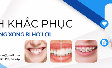 CÁCH KHẮC PHỤC TÌNH TRẠNG NIỀNG RĂNG XONG BỊ HỞ LỢI