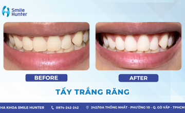 TẨY TRẮNG RĂNG TẠI NHÀ BẰNG MÁNG TẨY TRẮNG