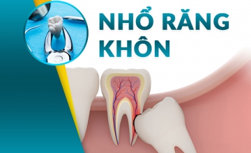 NHỔ RĂNG KHÔN AN TOÀN, KHÔNG ĐAU, KHÔNG SƯNG