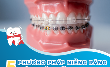 CÁC PHƯƠNG PHÁP NIỀNG RĂNG HIỆU QUẢ NHẤT 2023