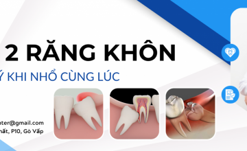 CÁC LƯU Ý KHI NHỔ 2 RĂNG KHÔN CÙNG LÚC