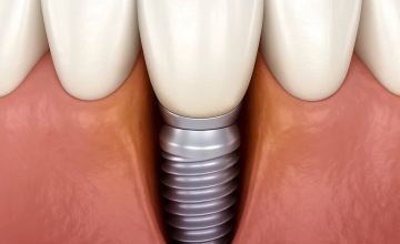 Antibacterial Therapy tại Nha Khoa Smile Hunter: Giảm 90% Biến Chứng Viêm Nhiễm Implant