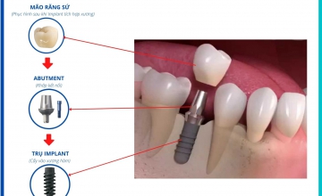 Ưu điểm trồng răng Implant