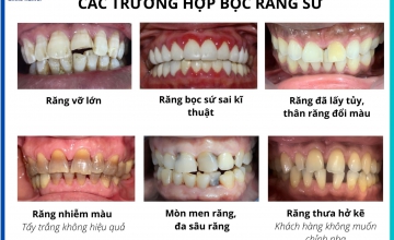 Bọc răng sứ đúng chỉ định nha khoa