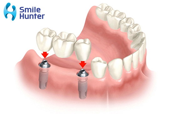 TRỒNG RĂNG/ CẤY GHÉP IMPLANT